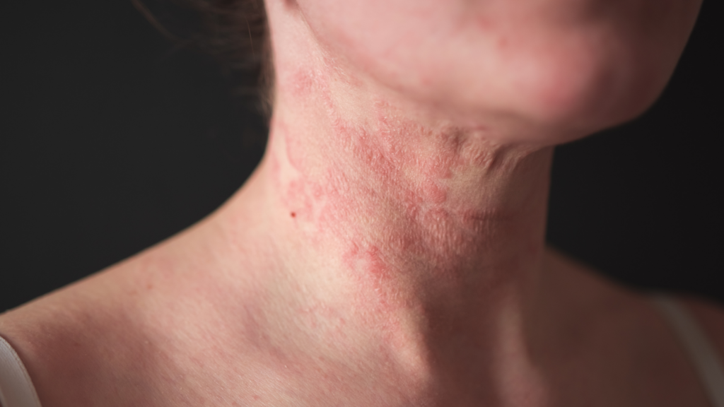 Dermatite Atópica Guia Completo sobre Causas, Sintomas e Tratamento