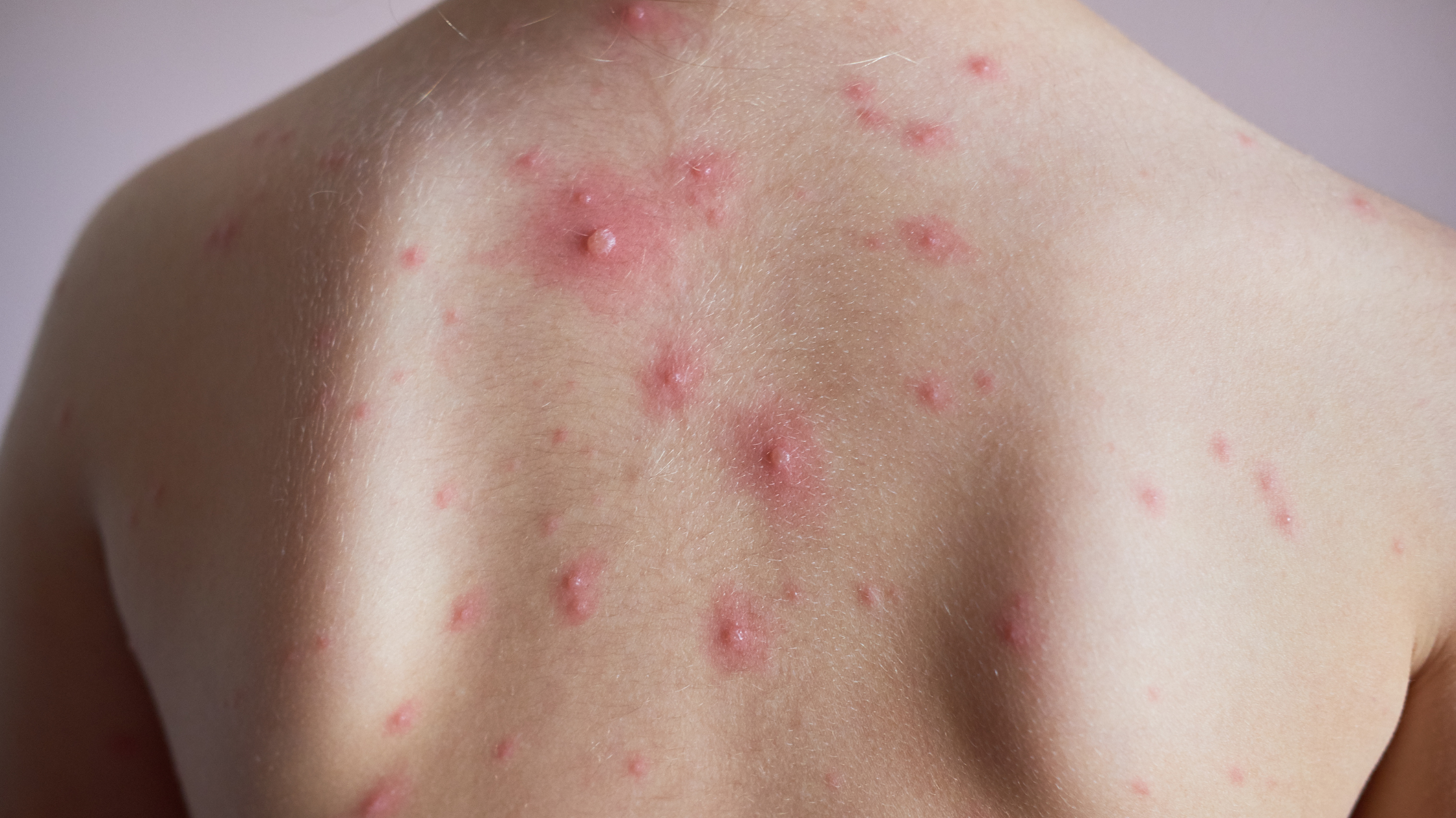 Catapora Sintomas, Tratamento, Prevenção e Cuidados Essenciais