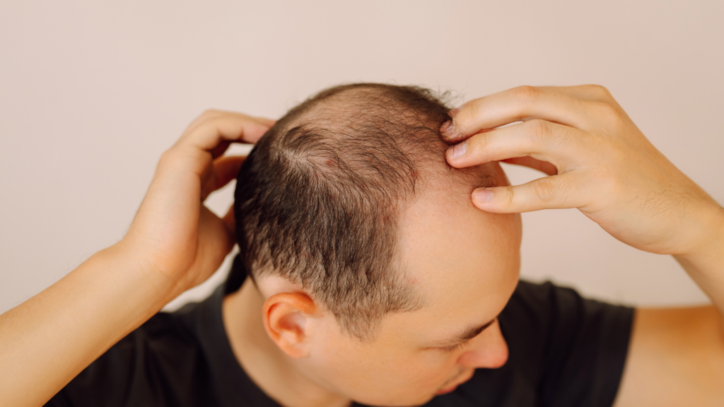 Queda de Cabelo Masculina Quando é Genética e Quando Investigar Entenda a diferença entre a calvície d
